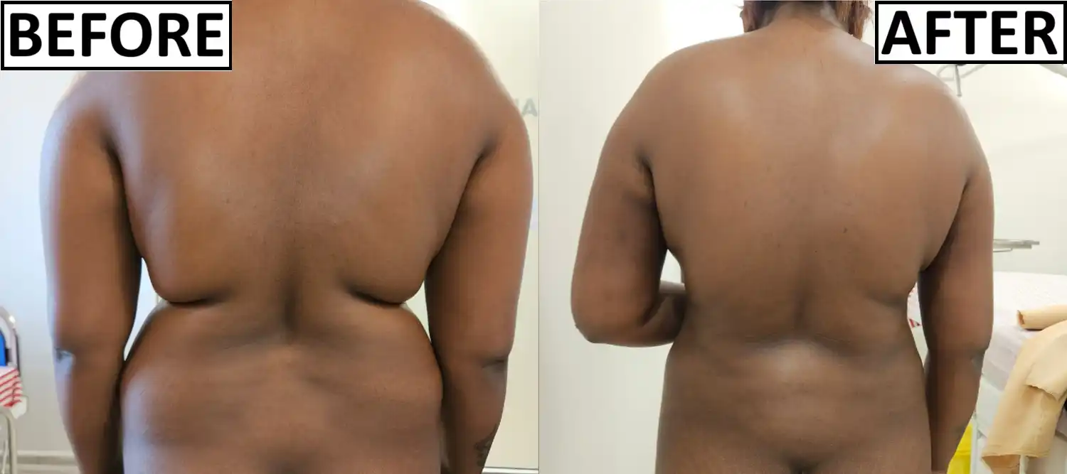 Before and after of 360 degree liposuction