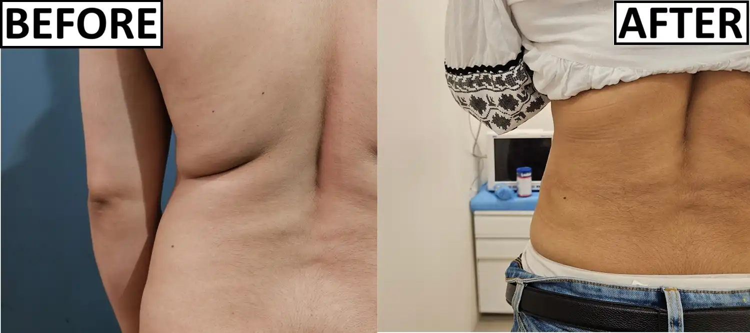 Before and after of back fat shaping