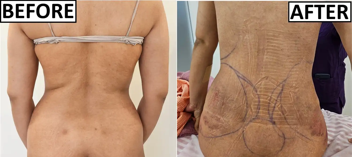 Before and early after photo of back liposuction