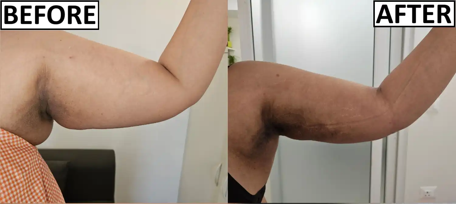 Before and after delayed ArmLiposuction by Dr. Amrika Seshadri