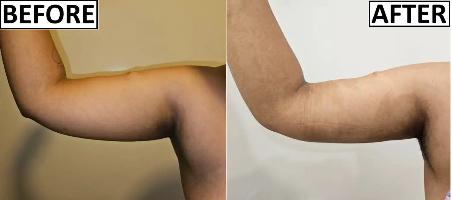 Before and after arm liposuction results by Dr. Amrika Seshadri