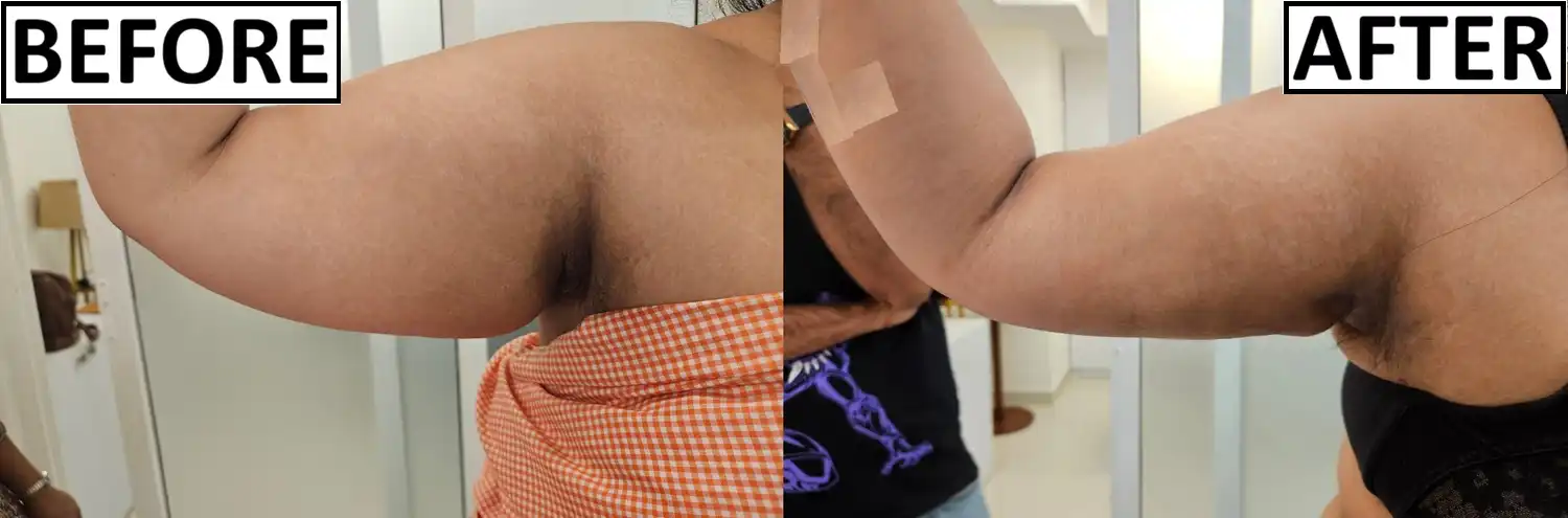 Before and after delayed ArmLiposuction by Dr. Amrika Seshadri