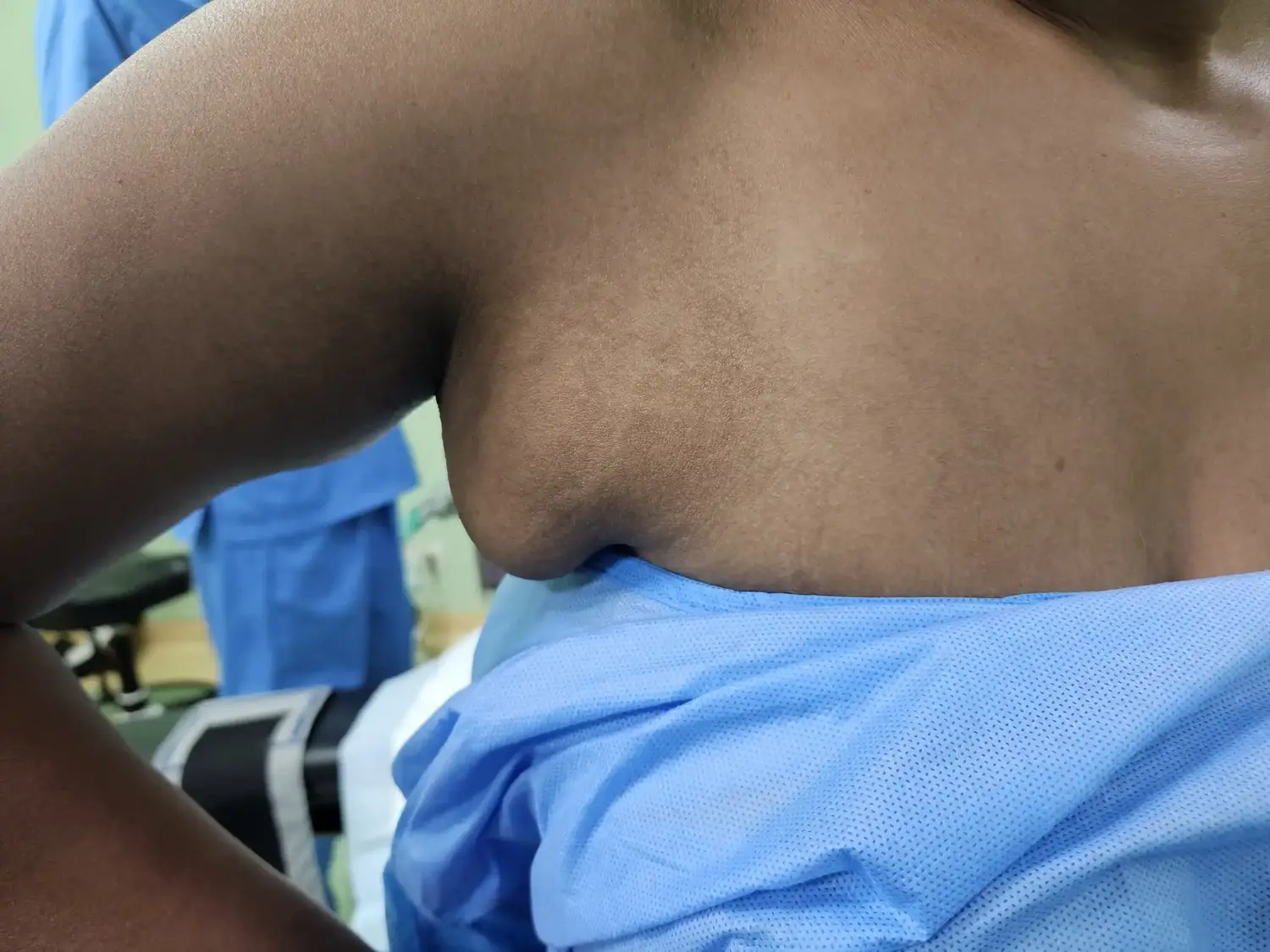 Before image of axillary breast