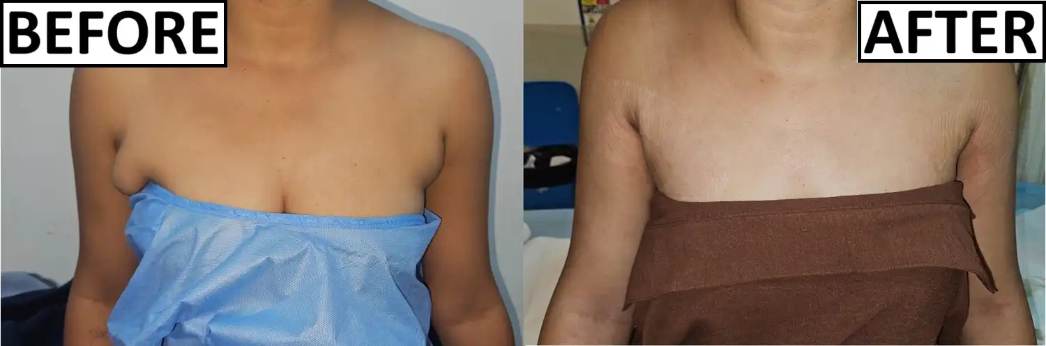 Before and after of axillary Breast
