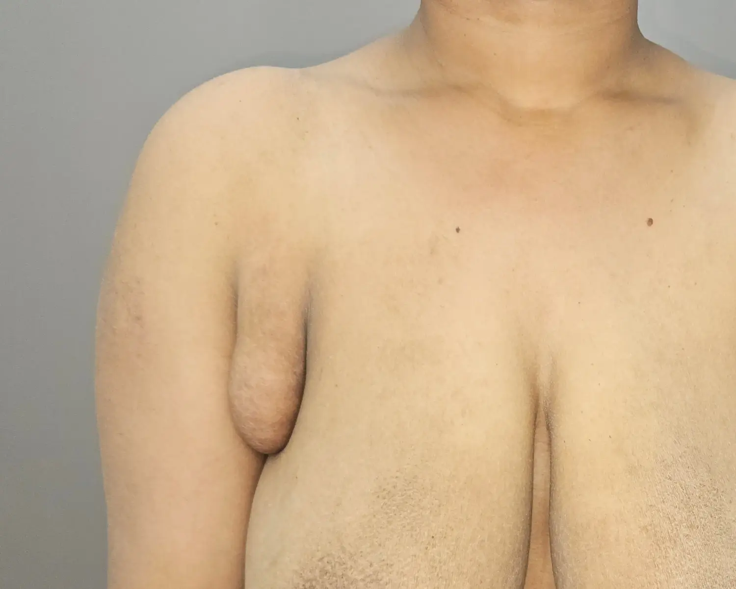 Before image of axillary breast