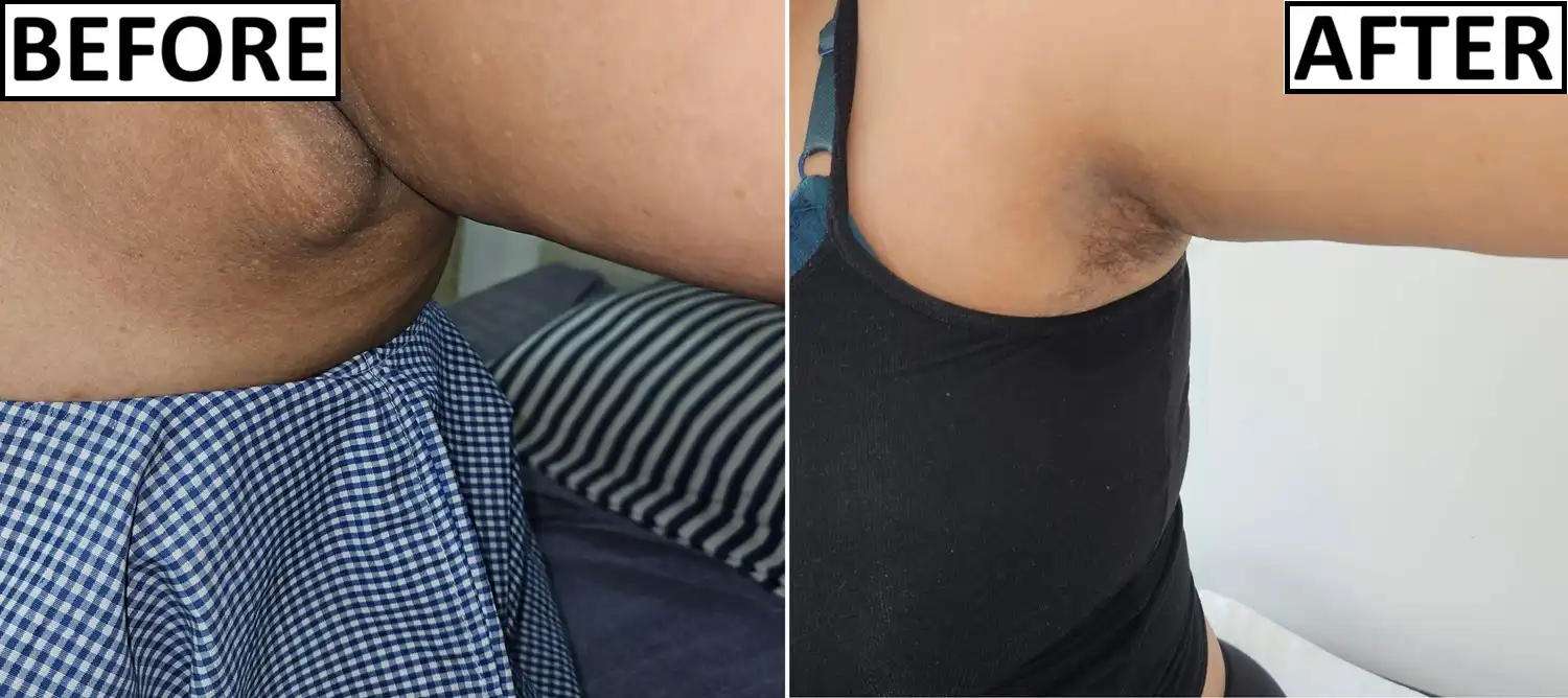 Before and after photo of axillary breast at 6 months