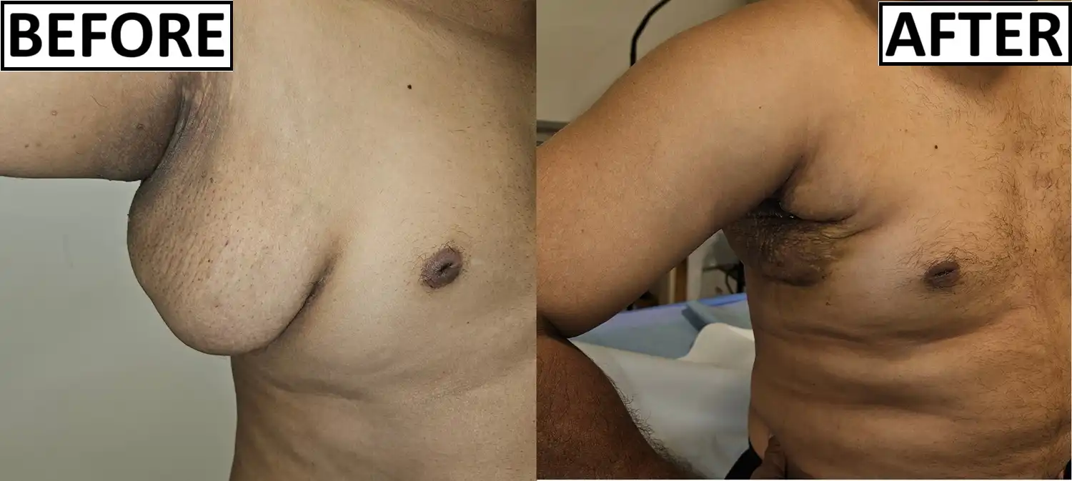 Axillary breast in a male patient