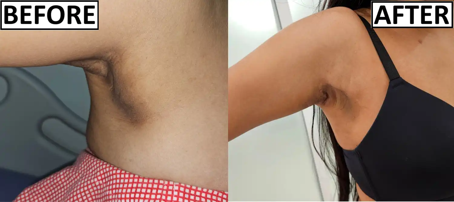 Before and after of axillary breast