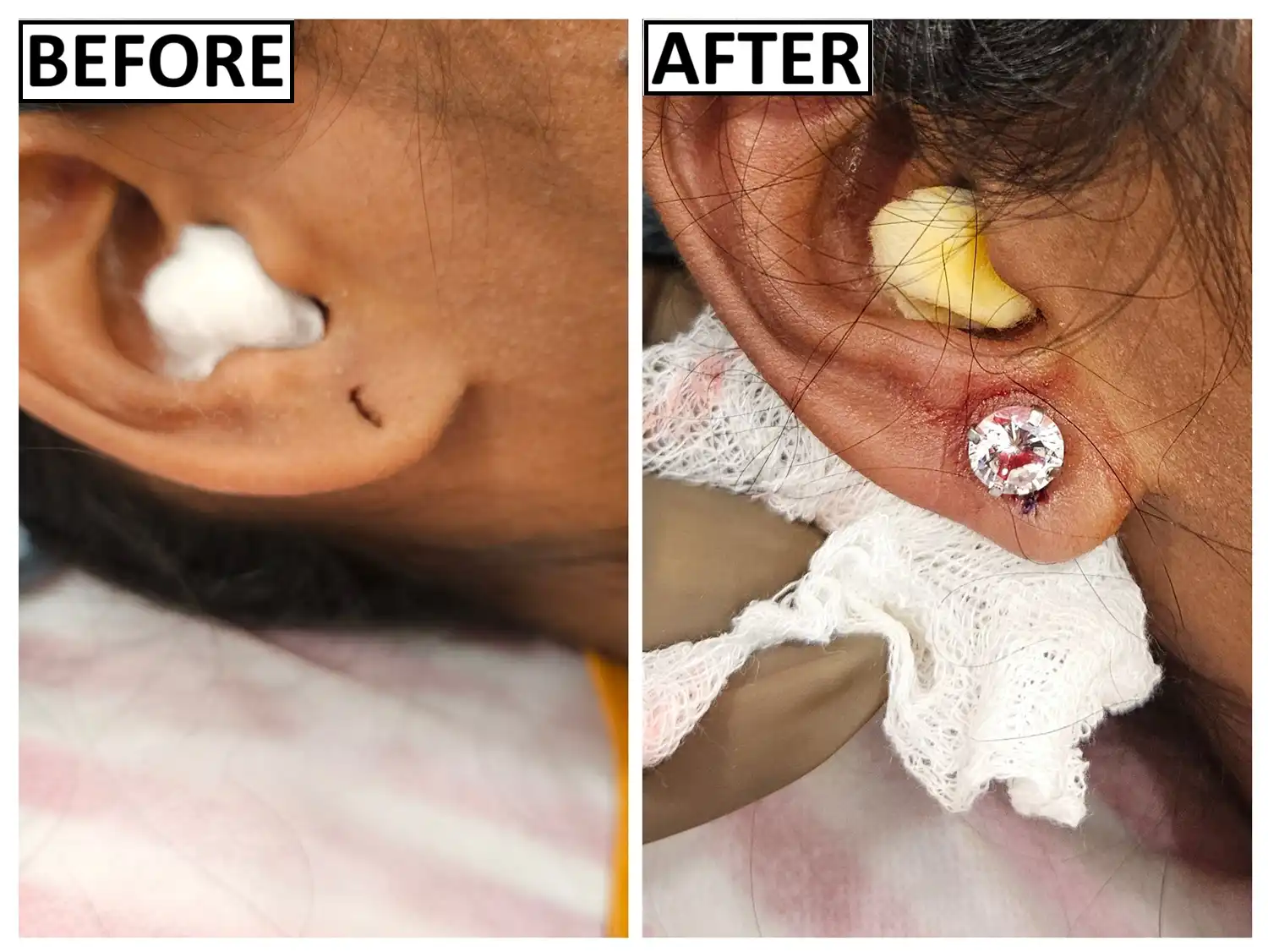 Before and after advanced Pardue flap reconstruction by Dr. Amrika Seshadri