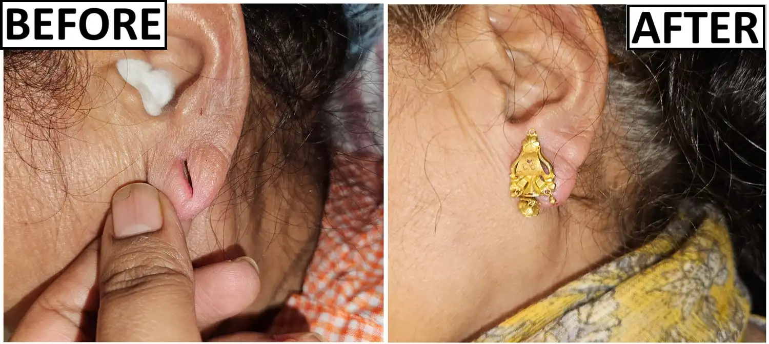 Before and after channel safeguarding by Dr. Amrika Seshadri