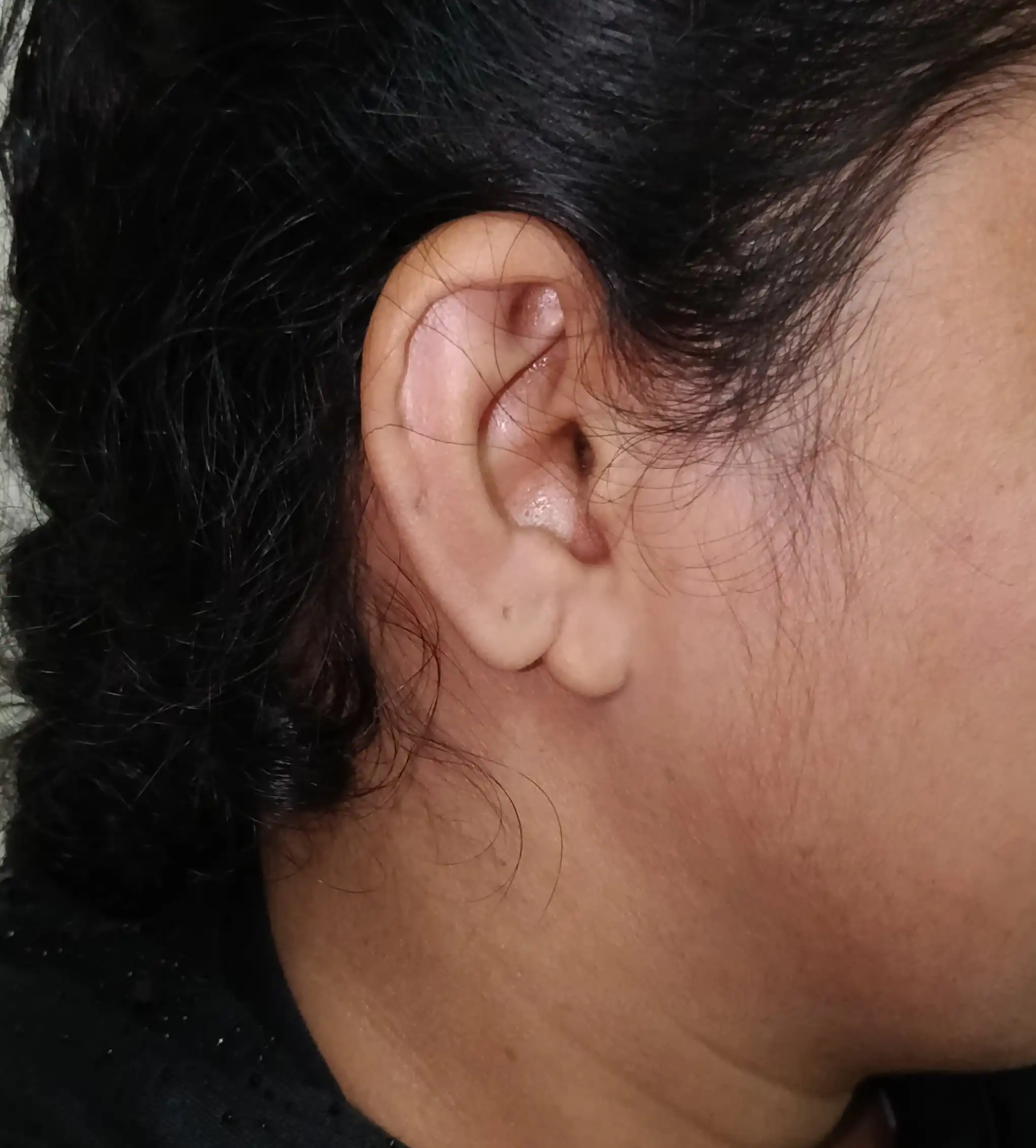 notched earlobe