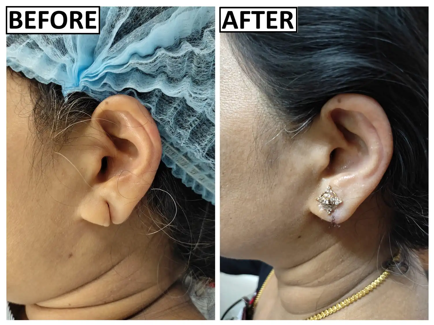 Before and after Pardue flap technique by Dr. Amrika Seshadri