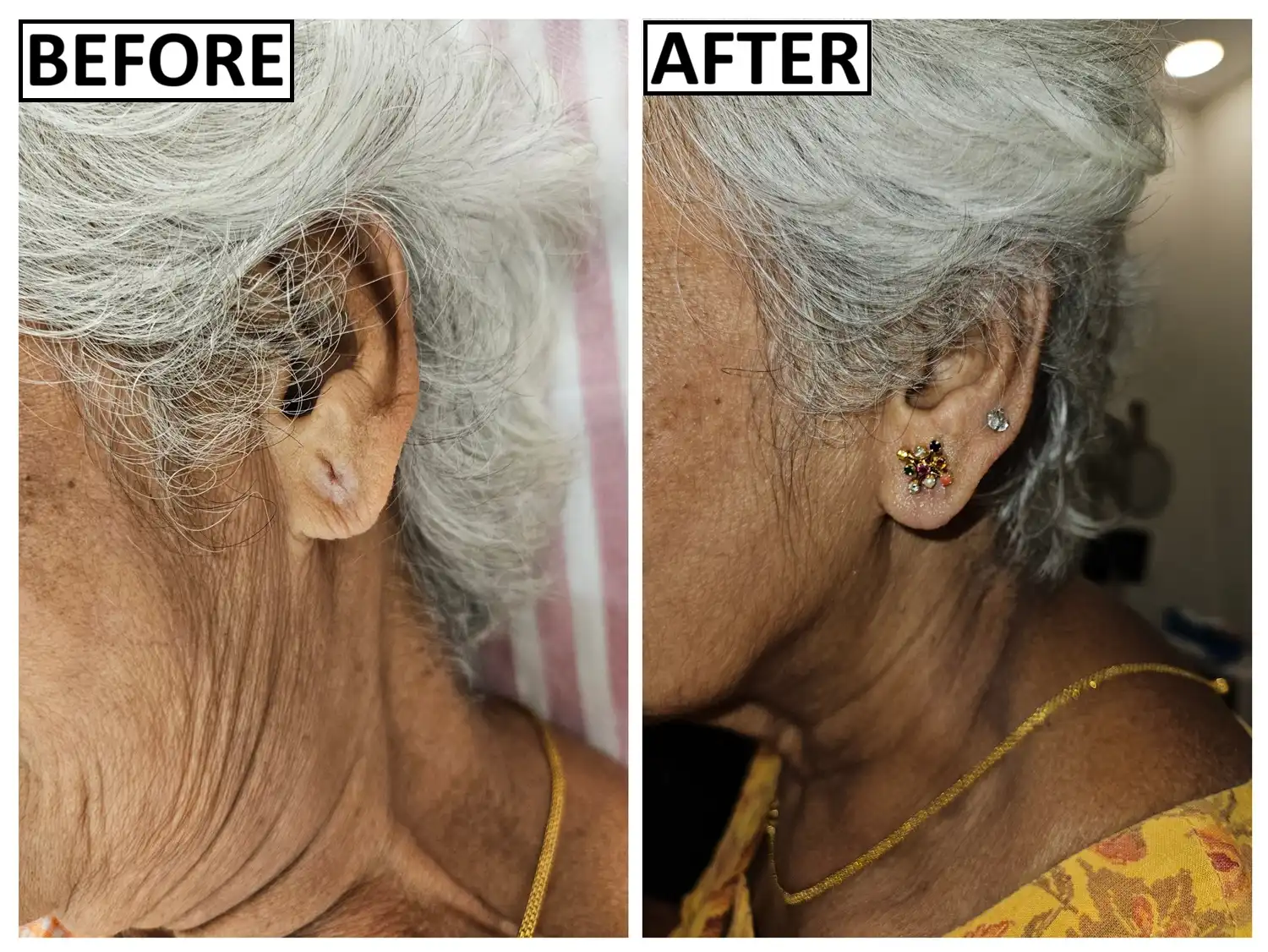 Before and after temporary earring placement by Dr. Amrika Seshadri