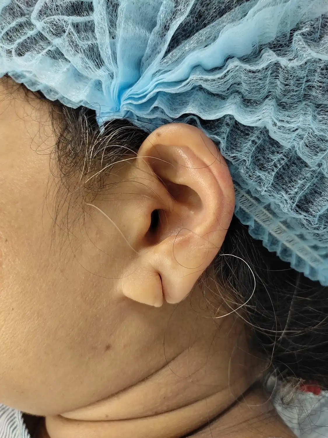 torn earlobe repair