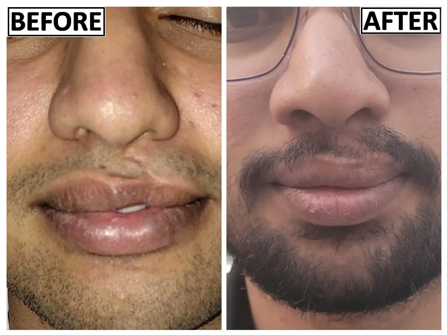 Before and after picture of adult cleft lip revision