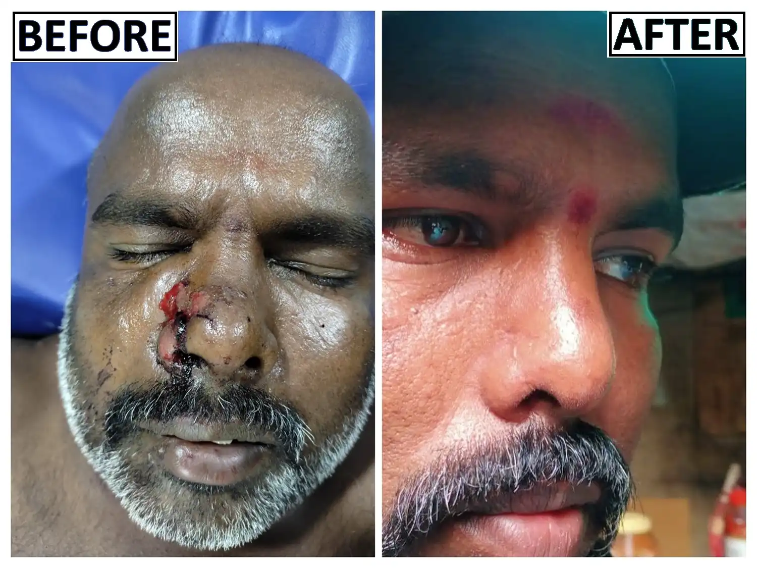 Before and after of nose injury
