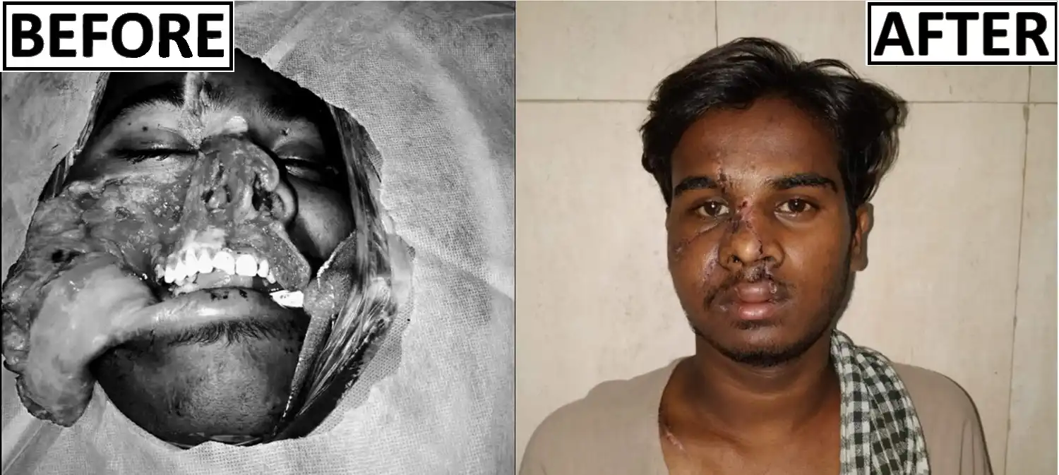 Before and after of face injury Anonymization required