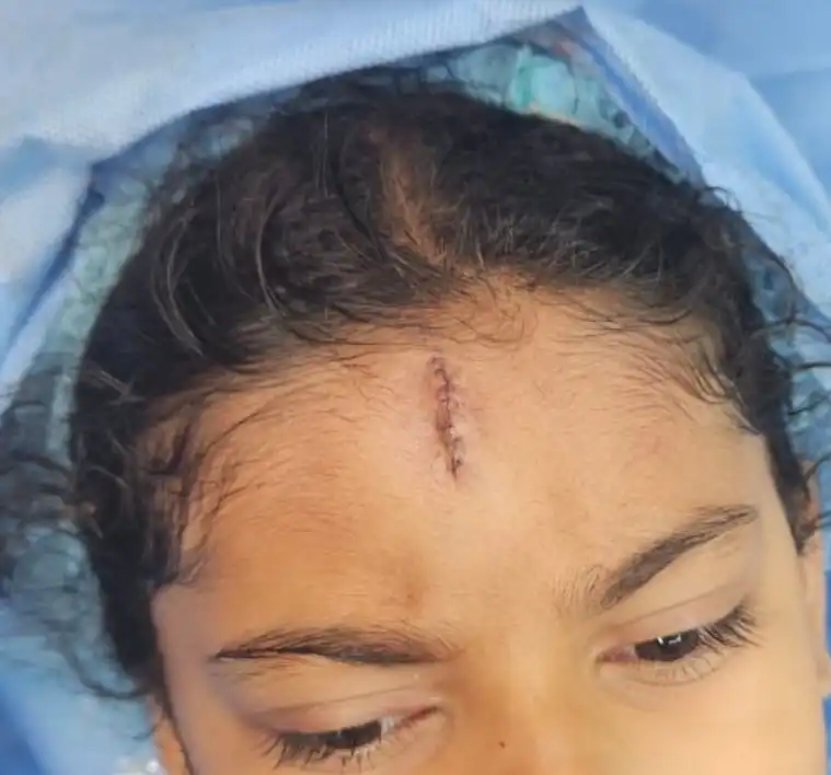 Fine sutures for scar repair