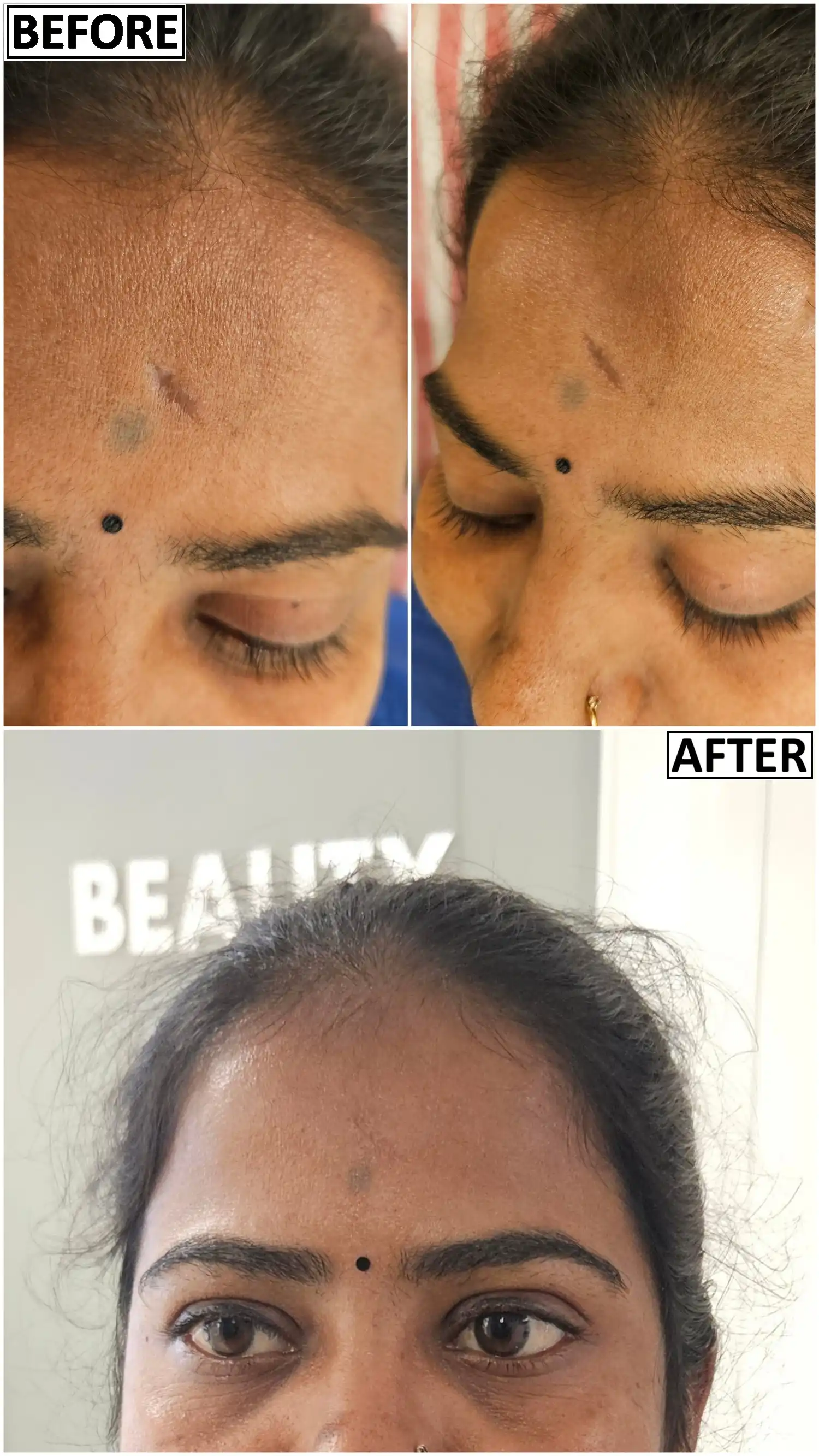 Before and after images of scar revision old scar correction