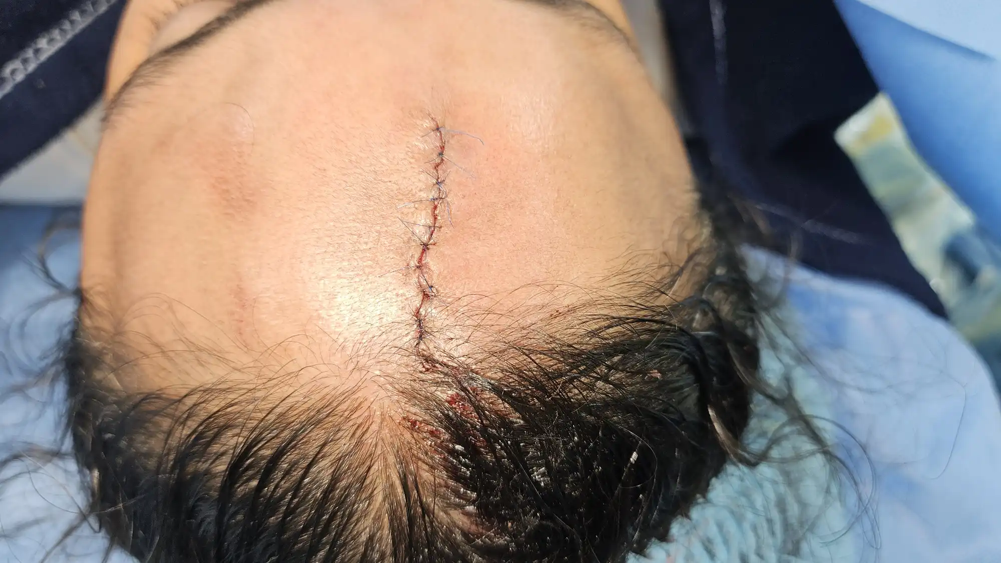 Fine sutures placed during cut wound repair