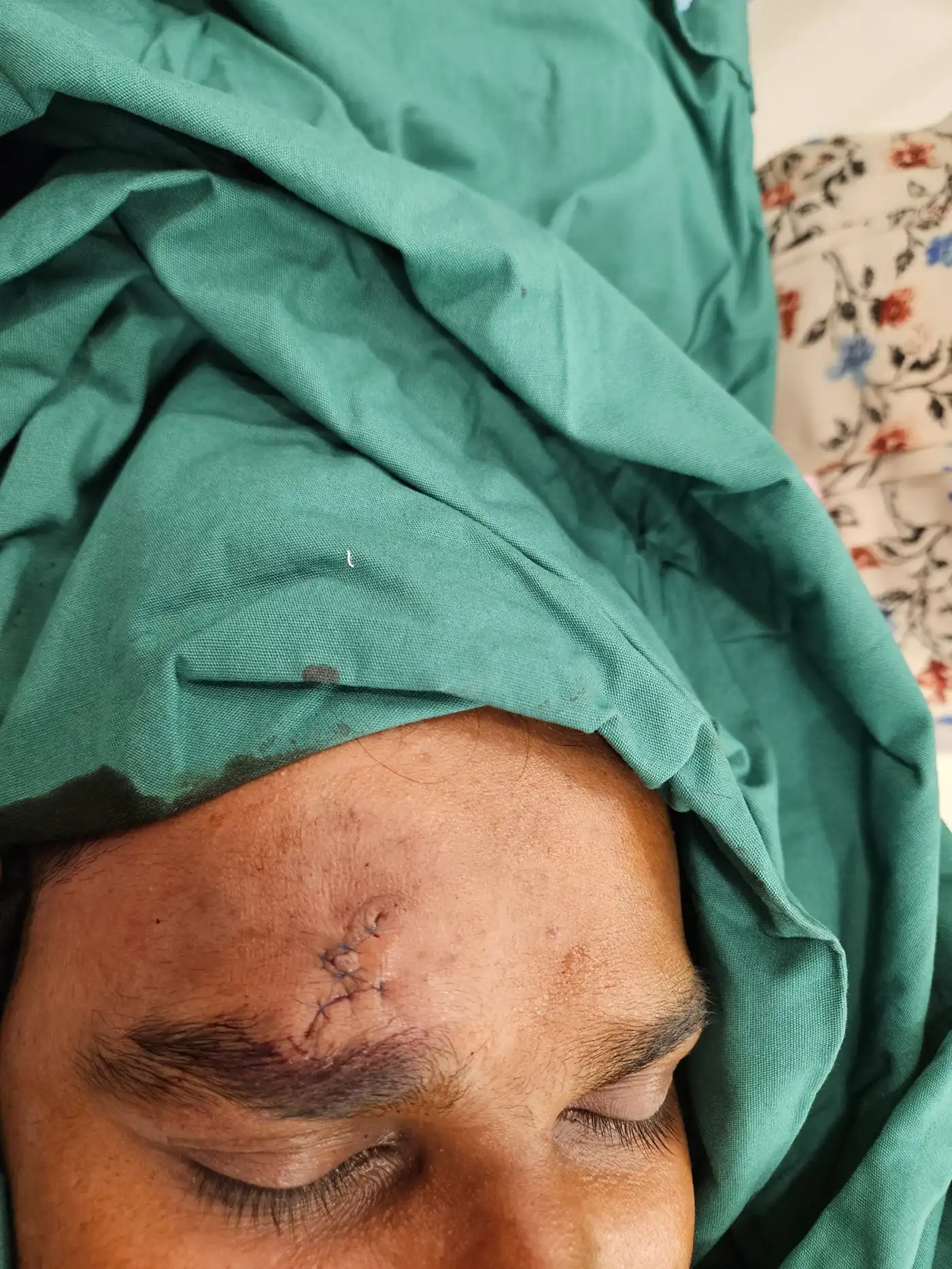 Z plasty for an old scar