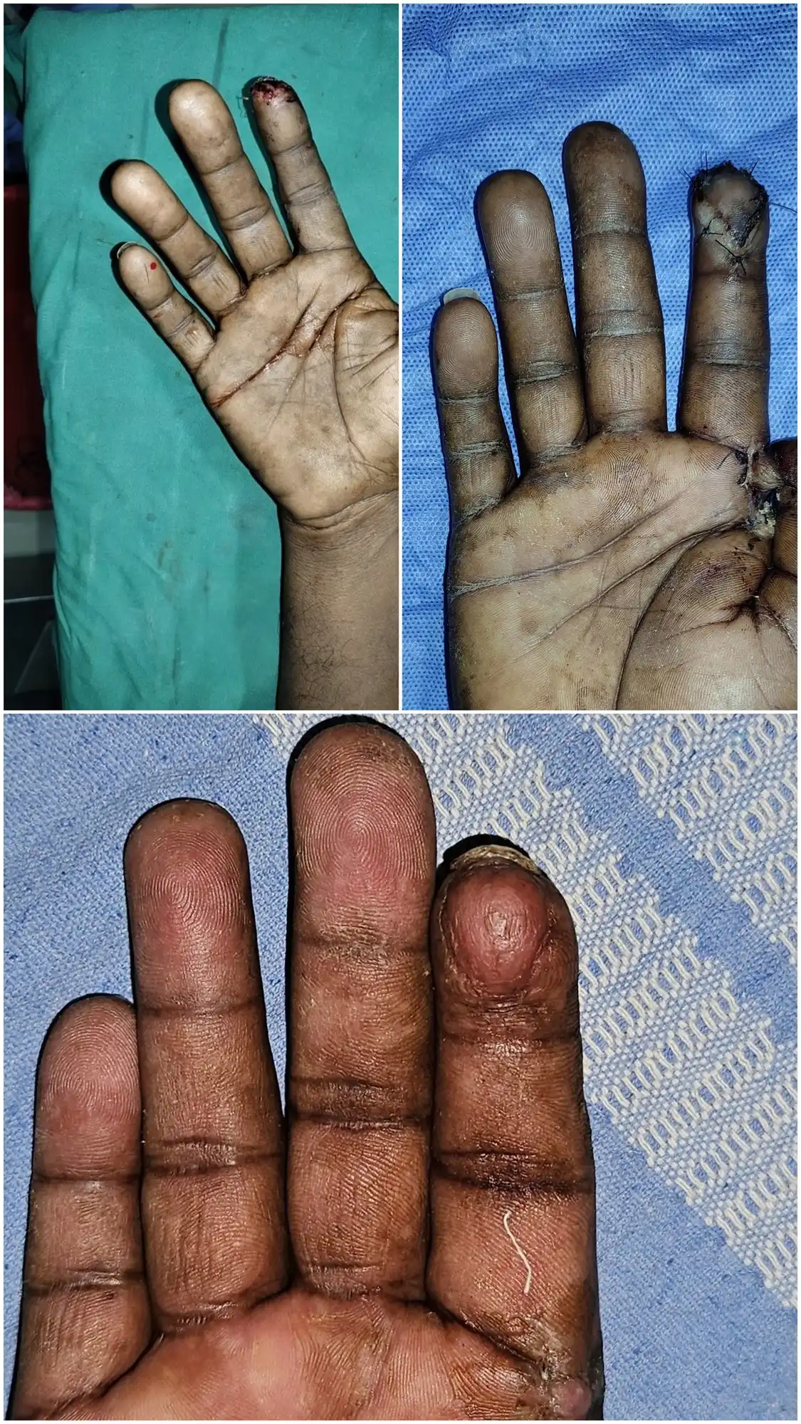 Before and after Atasoy flap reconstruction case by Dr. Amrika Seshadri