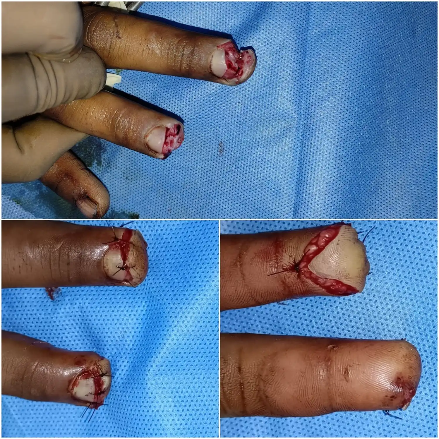 Before and after Atasoy flap reconstruction by Dr. Amrika Seshadri