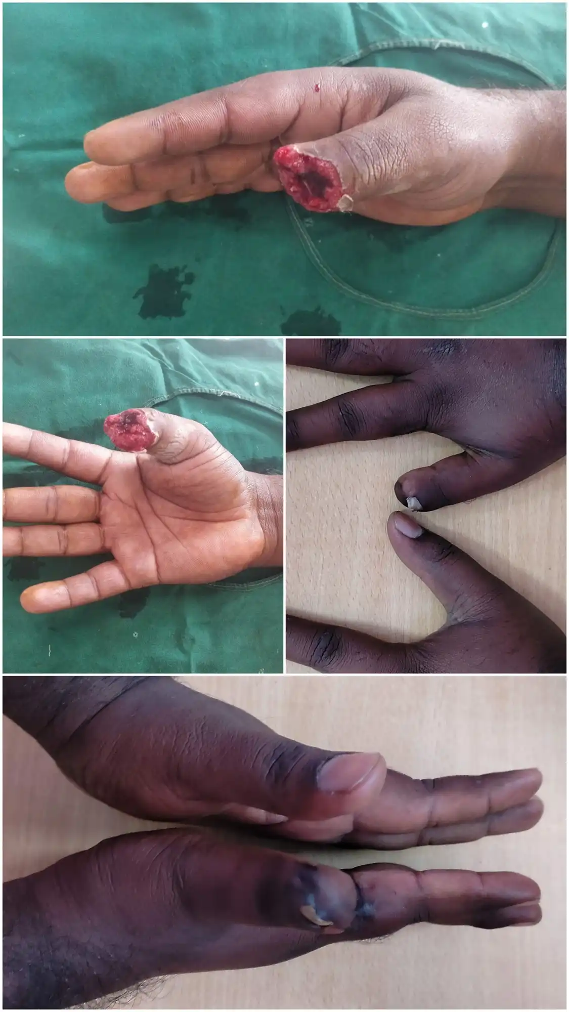 Before and after cross-finger flap reconstruction case by Dr. Amrika Seshadri