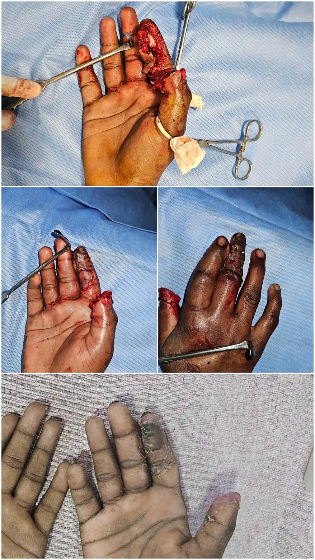Before and after cross-finger flap reconstruction by Dr. Amrika Seshadri
