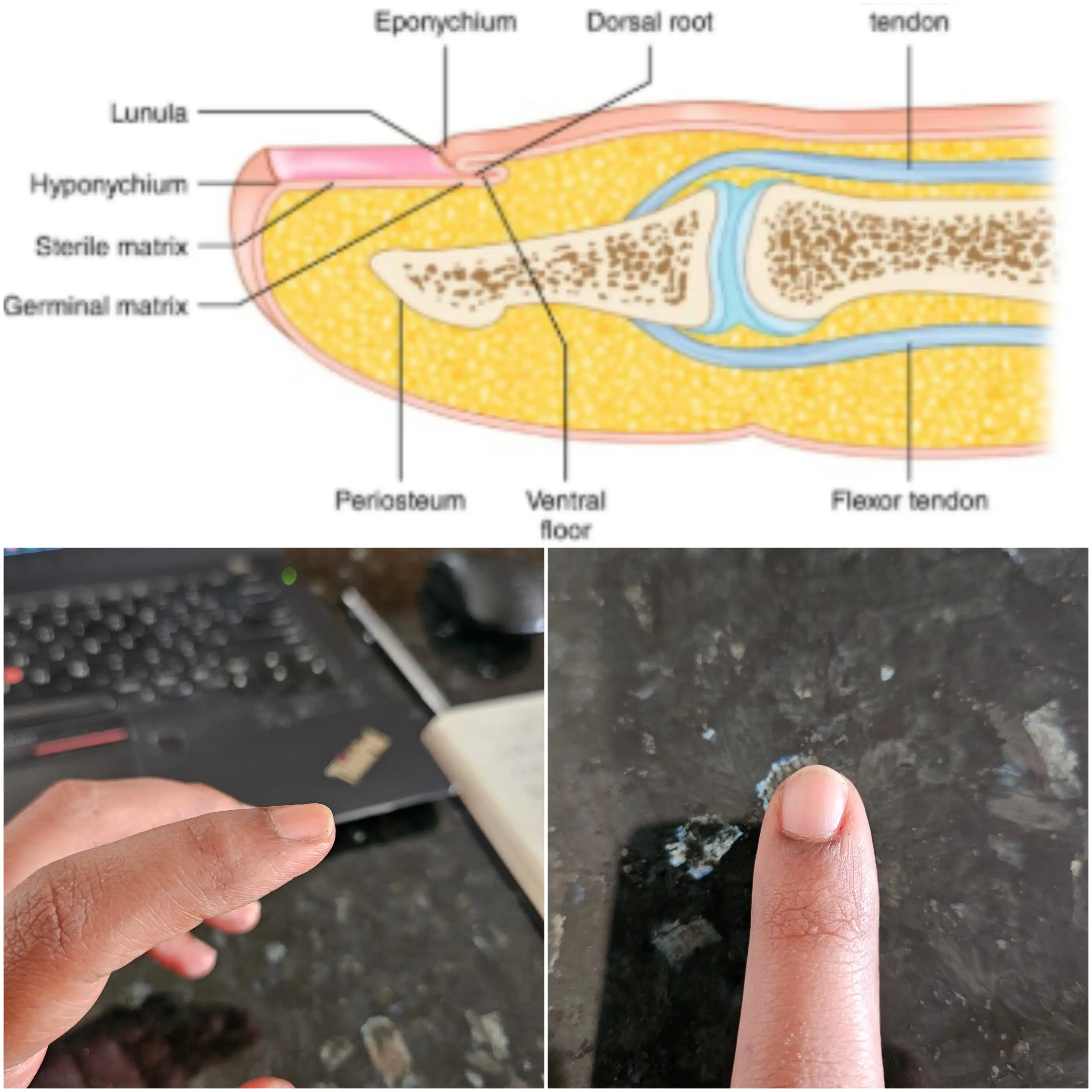 Before and after distal phalanx anatomy by Dr. Amrika Seshadri