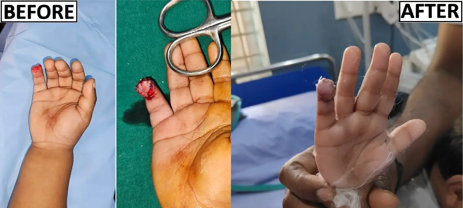 Before and after fingertip anatomy by Dr. Amrika Seshadri