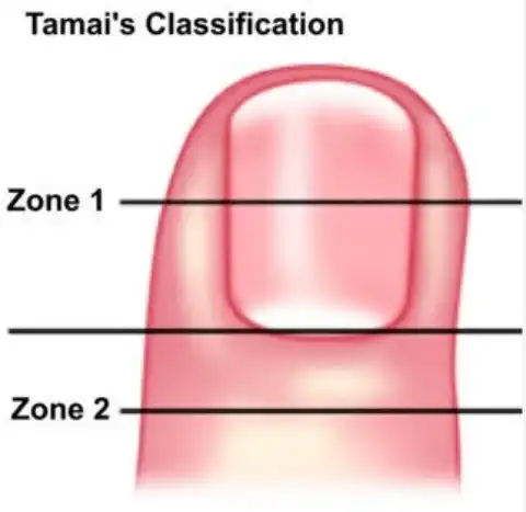 Before and after fingertip injury classification by Dr. Amrika Seshadri