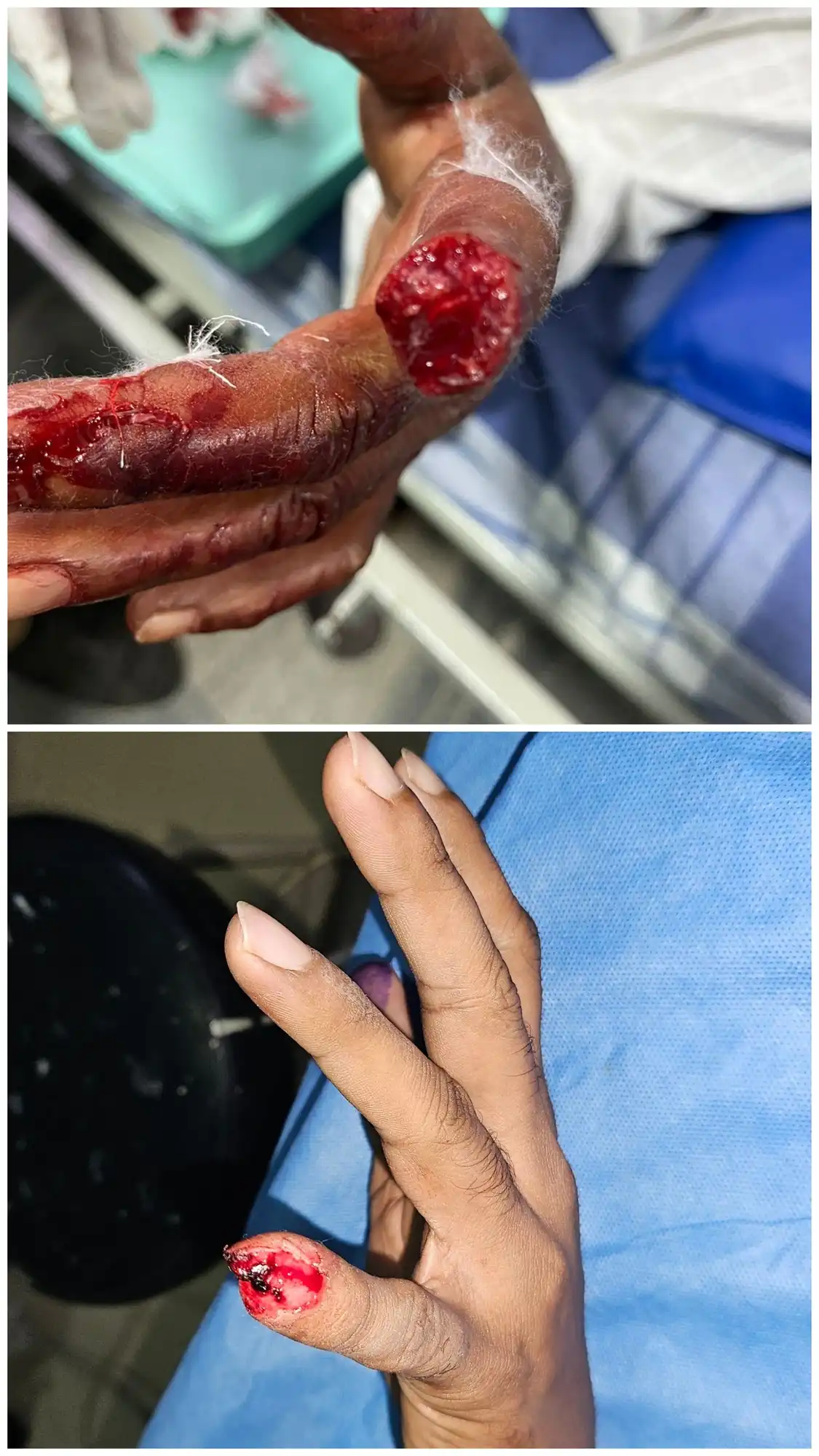 Before and after Tamai classification by Dr. Amrika Seshadri