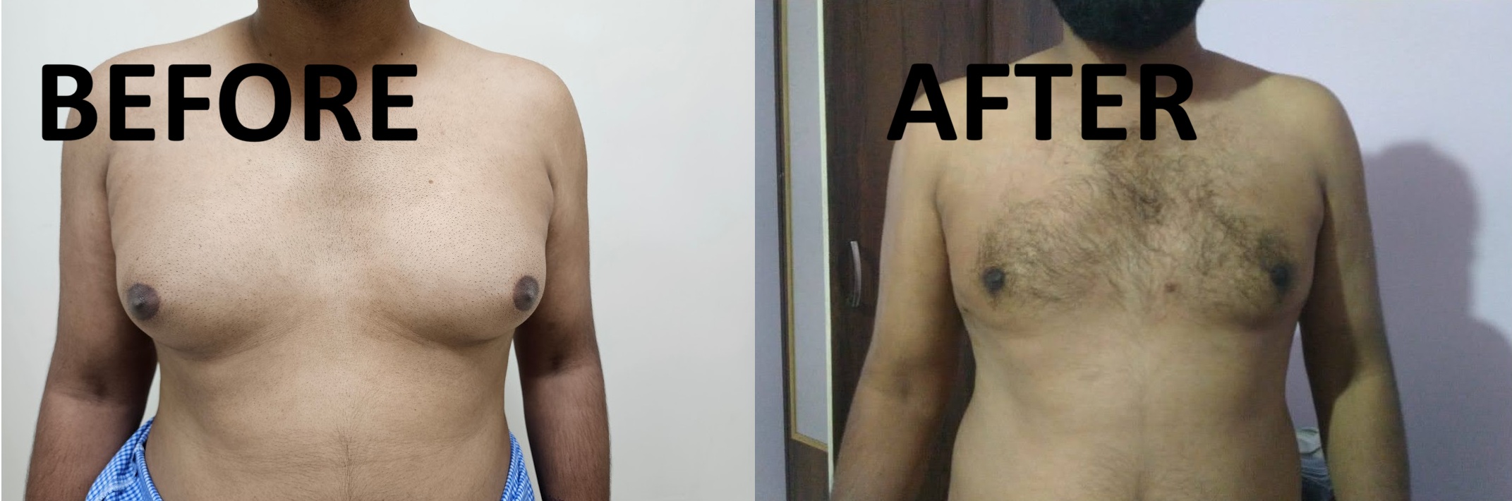 Gynaecomastia