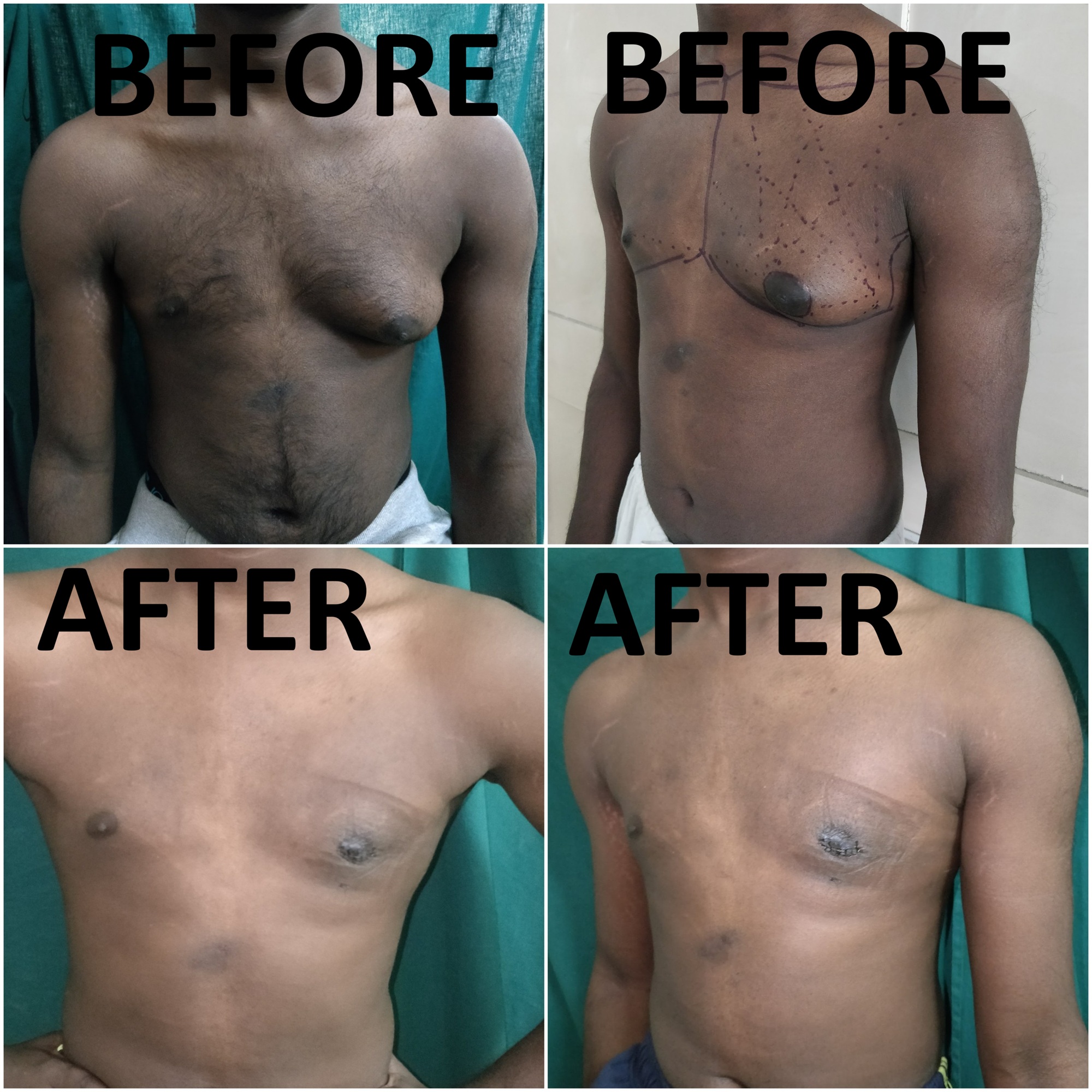 Gynaecomastia