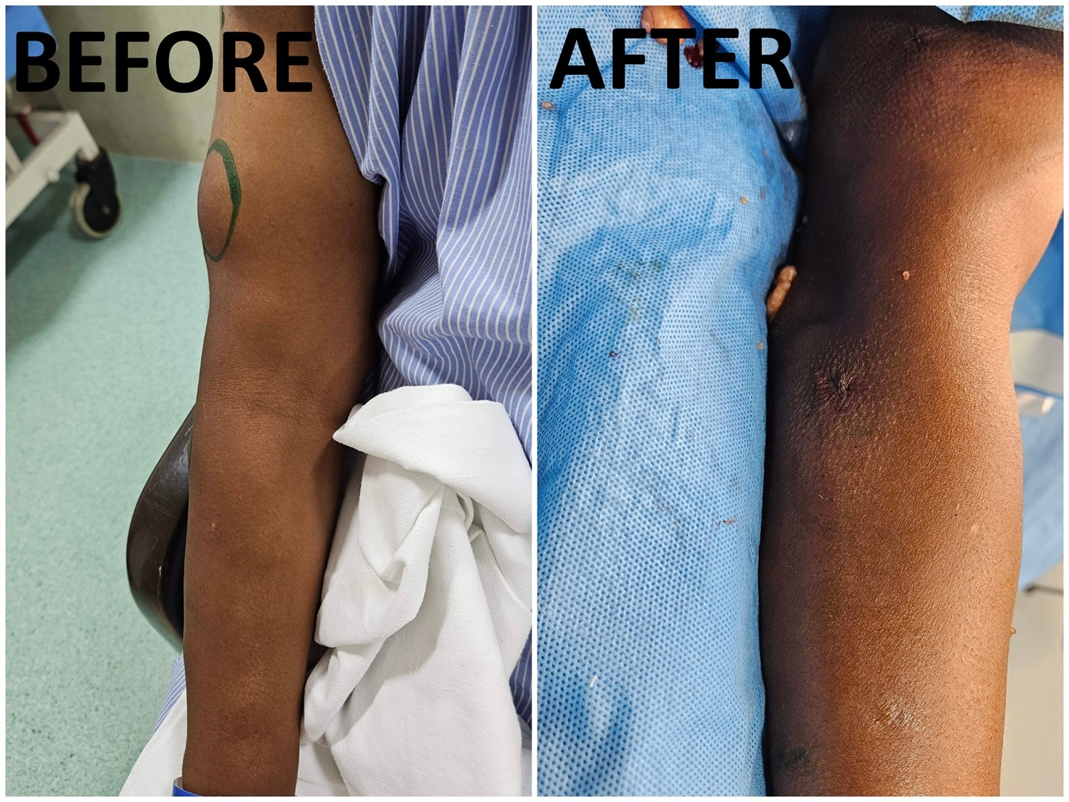 Lipoma