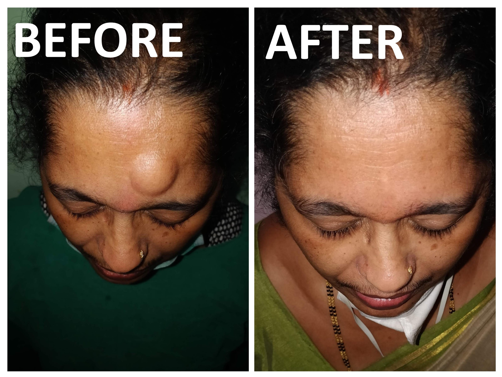 Lipoma