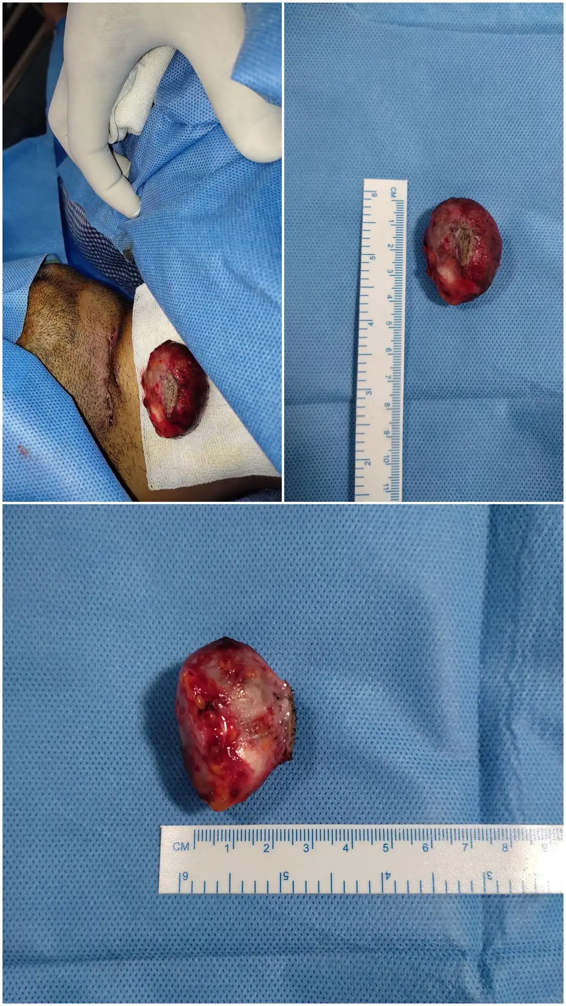Before and after histopathology analysis by Dr. Amrika Seshadri