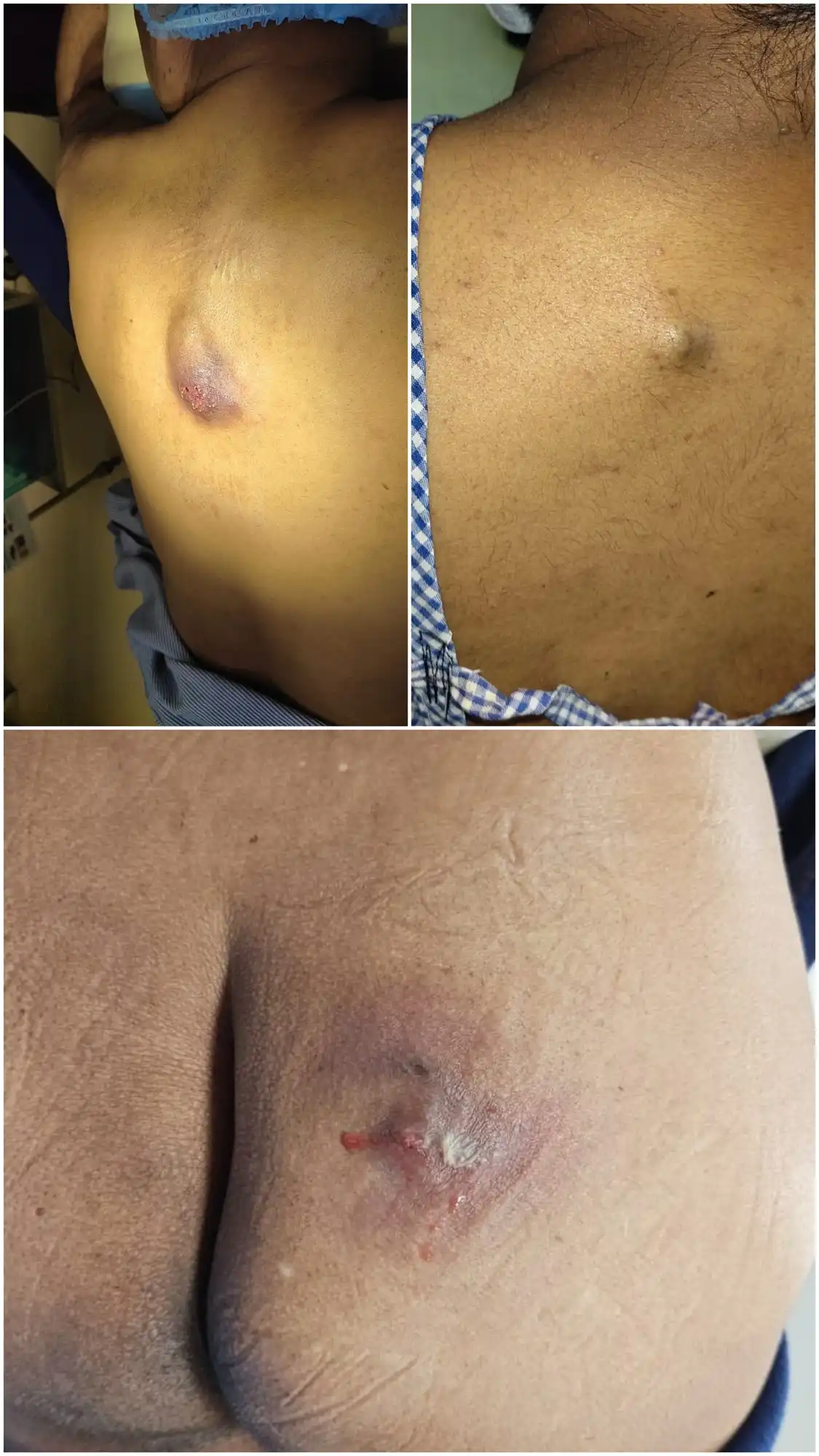 Before image of sebaceous cyst
