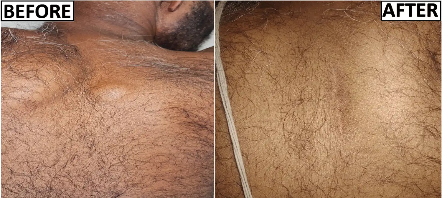 before and after of sebaceous cyst fine scar