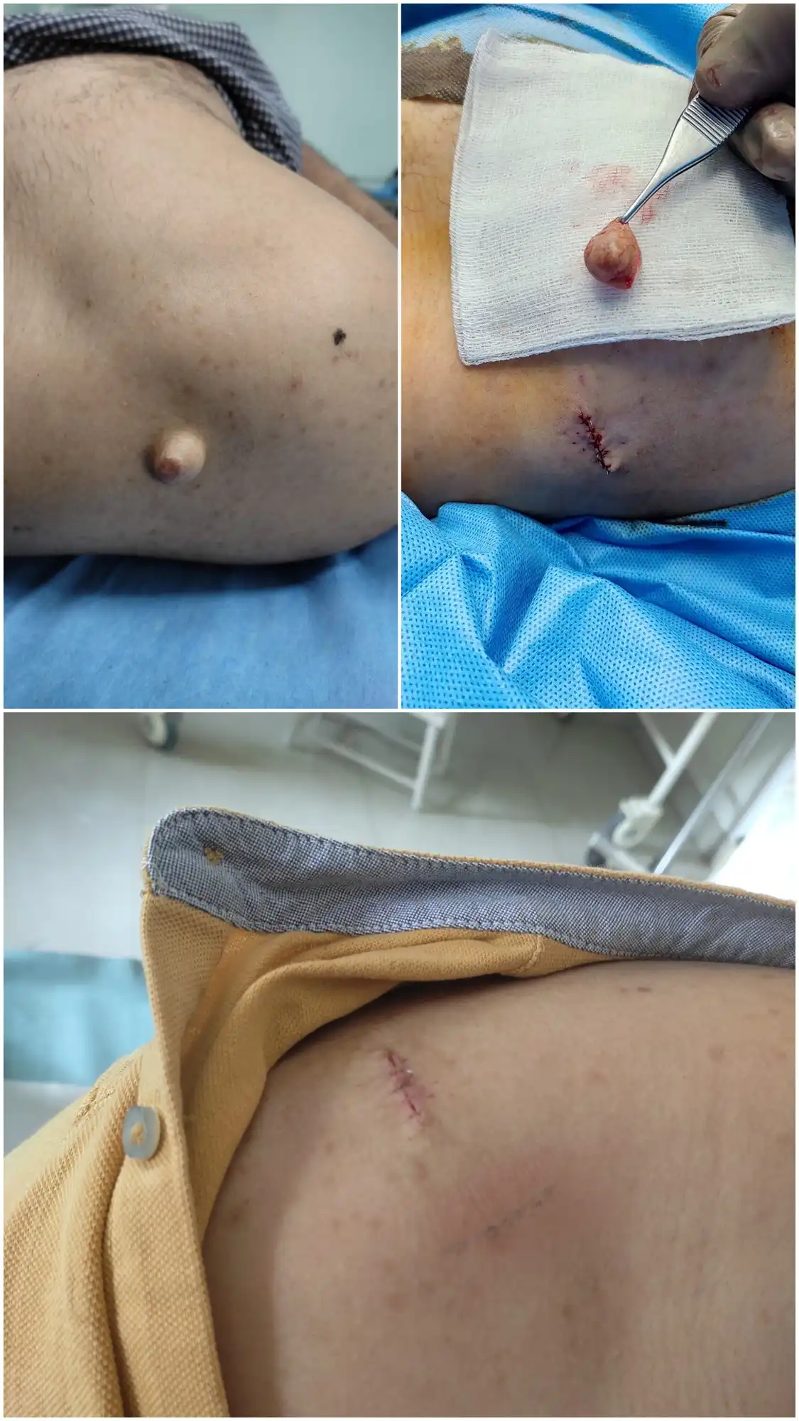 Before and after sebaceous cyst