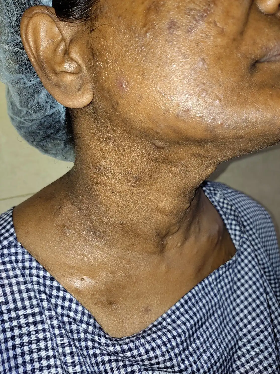 Steatoma