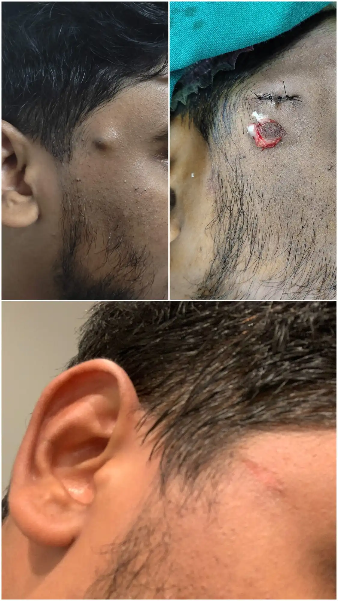 Before and after sebaceous cyst