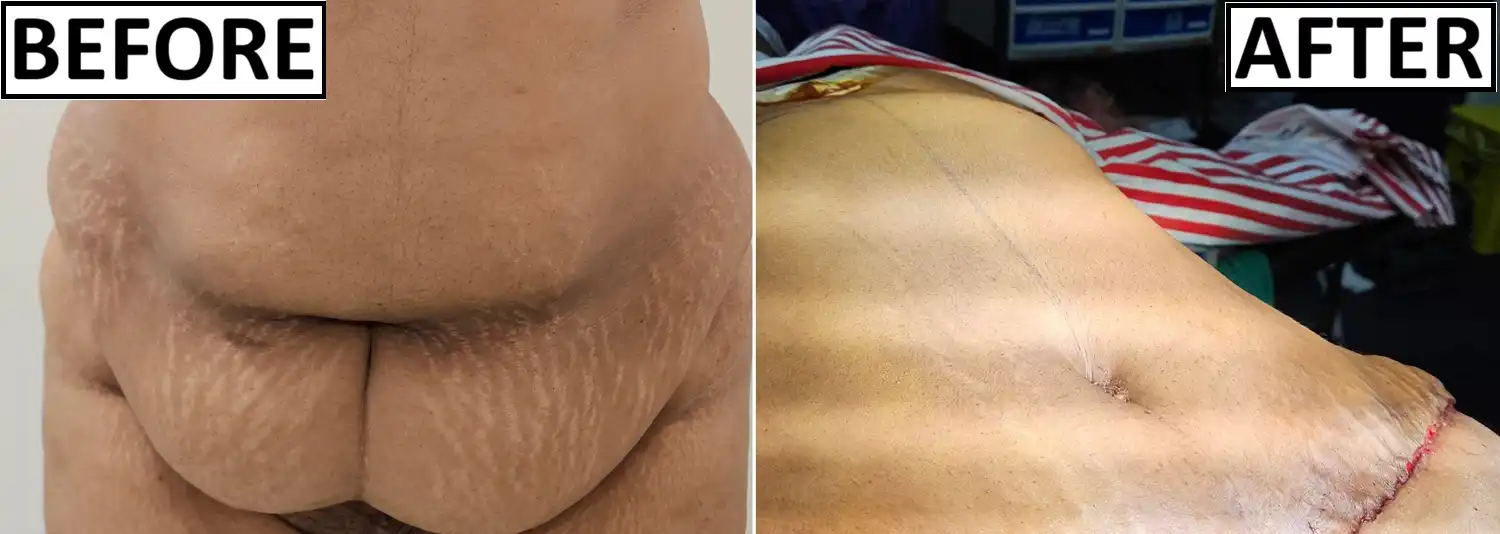 natural-umbilicoplasty