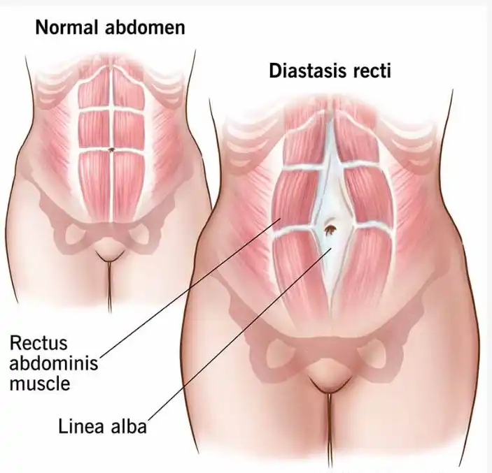 Normal abdomen and diastasis recti