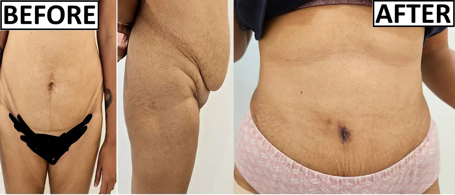 before and after Tummy tuck