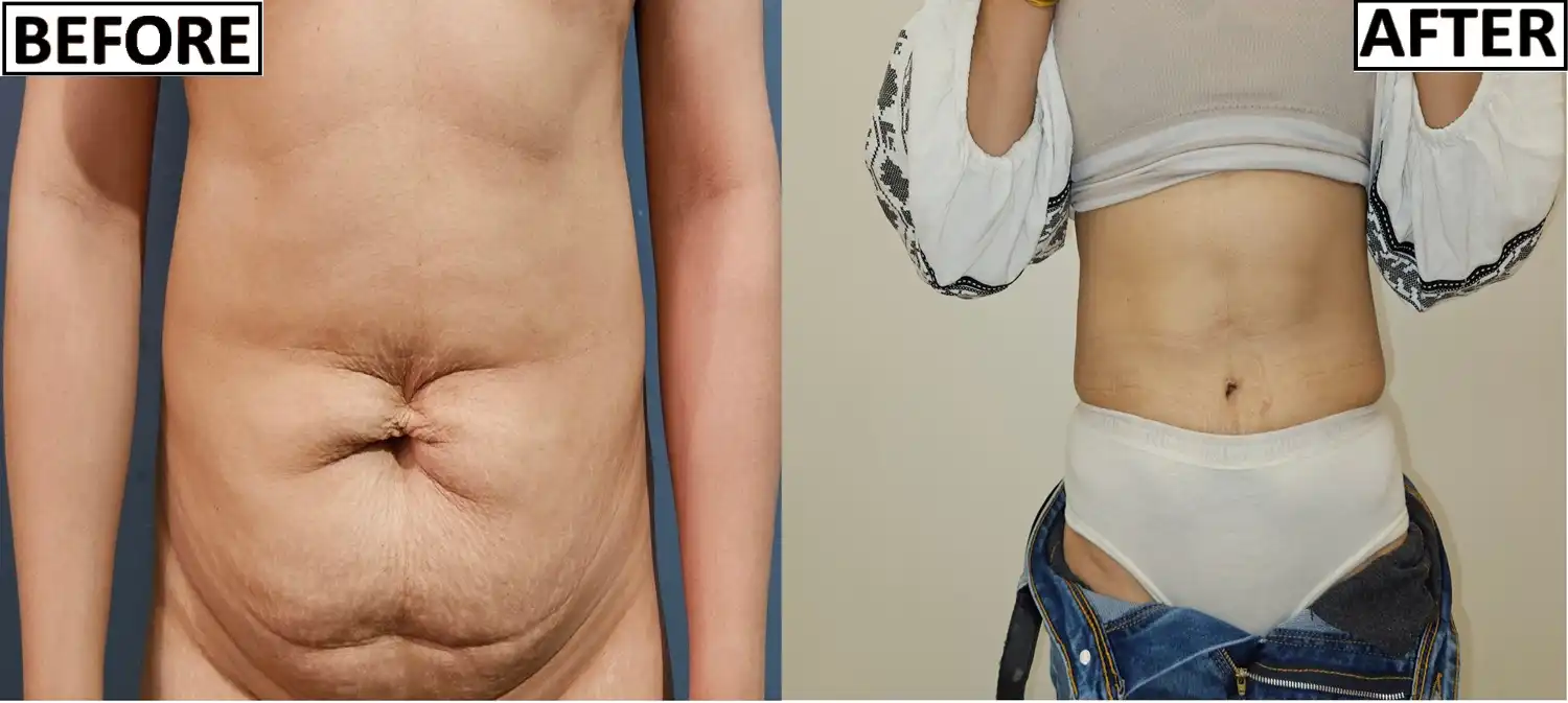 Tummy Tuck