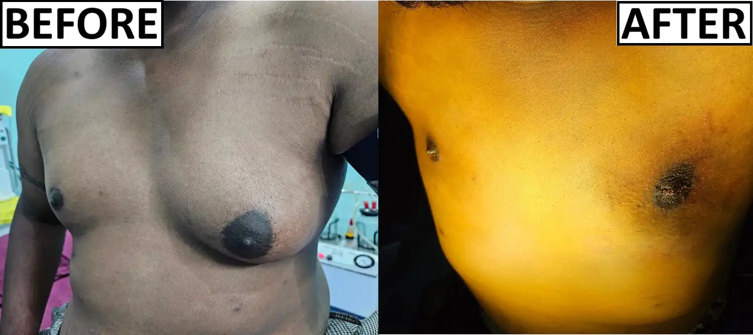 Before and after of gynaecomastia during surgery