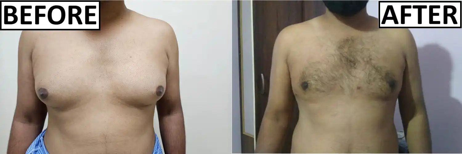 Before and after of gynaecomastia surgery