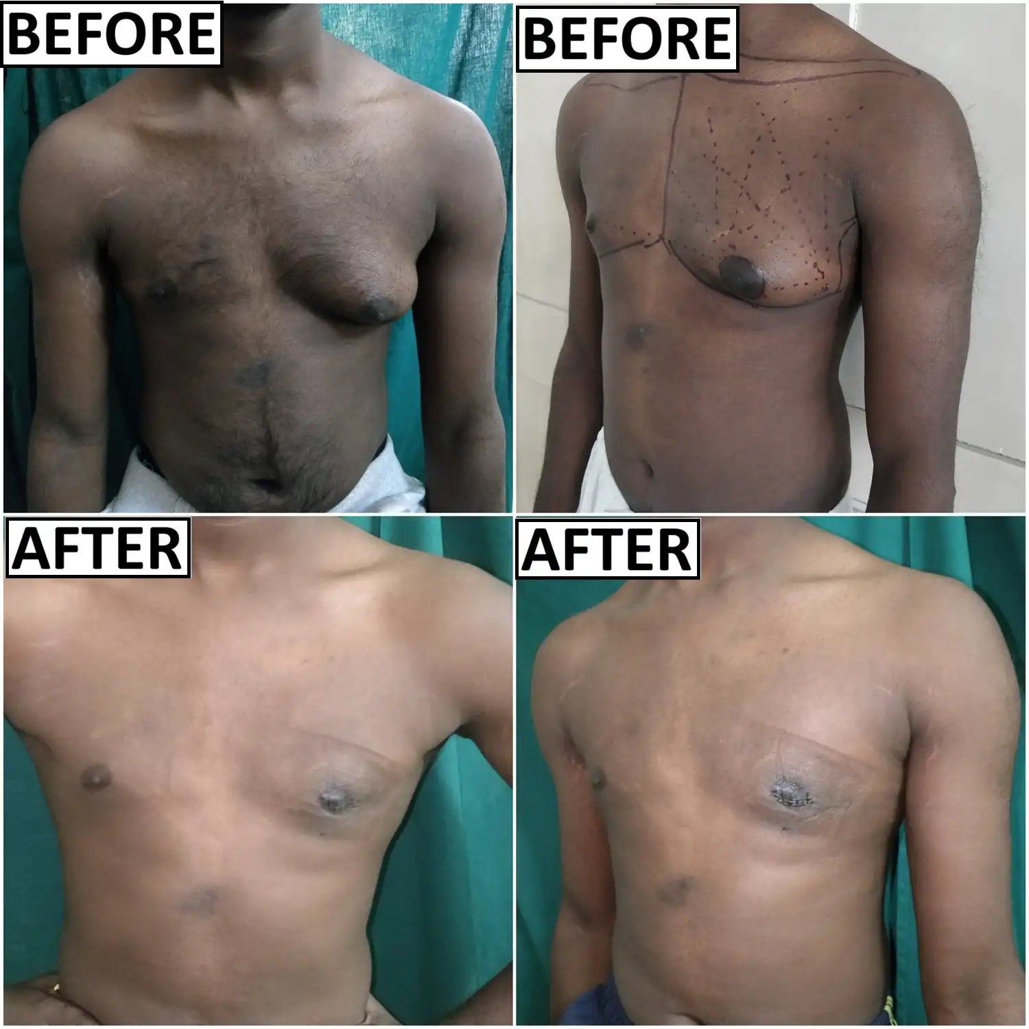 Before and after images of gynaecomastia surgery